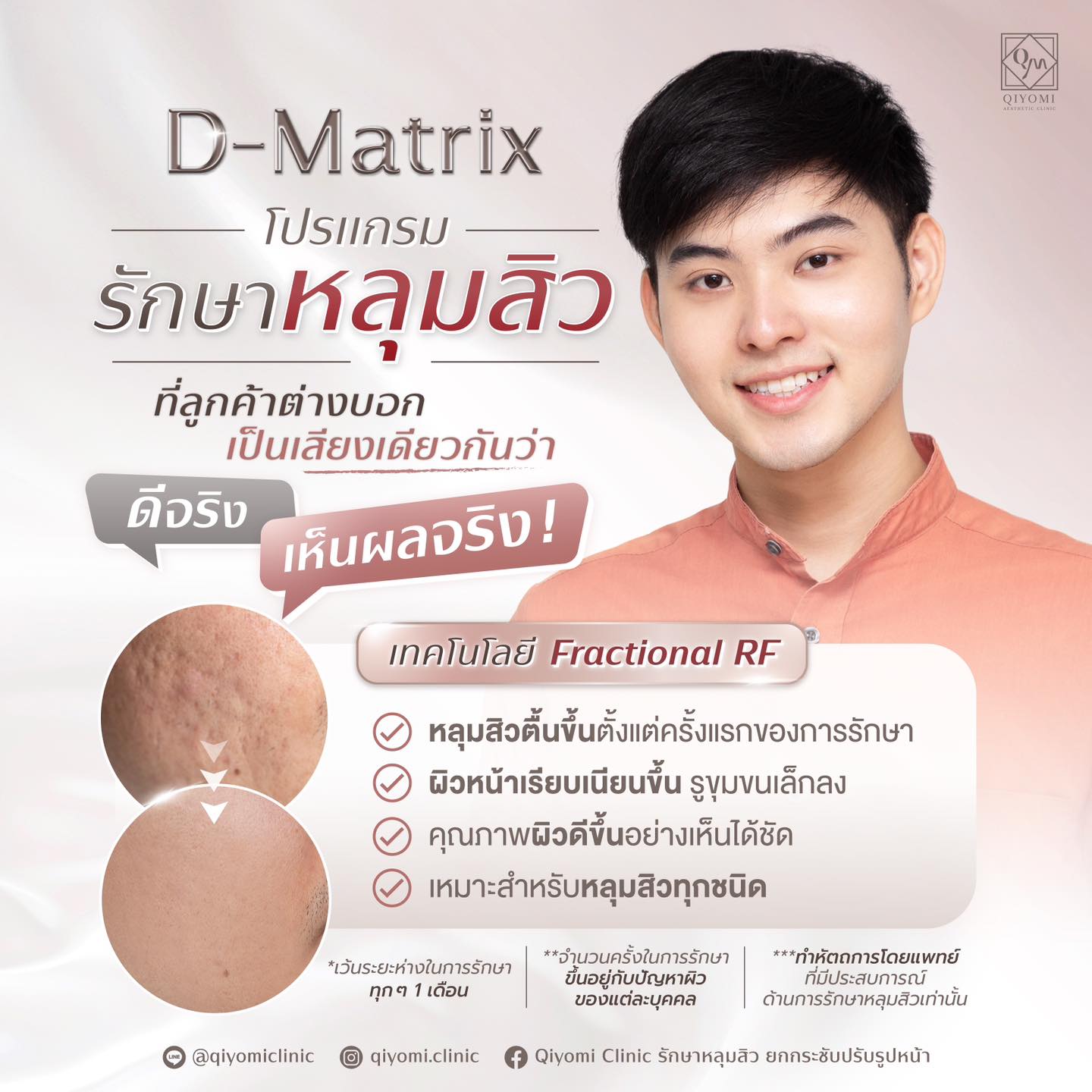 D-matrix เป็นโปรแกรมรักษาหลุมสิวด้วยพลังงาน Fractional RF ก็คือคลื่นความถี่วิทยุแบบยิงเฉพาะจุดในระดับลึก แต่ไม่ทำลายผิวชั้นบน เหมาะกับการรักษาหลุมสิวโดยเฉพาะ รักษาได้ทั้งหลุมสิวแบบตื้นและแบบลึก