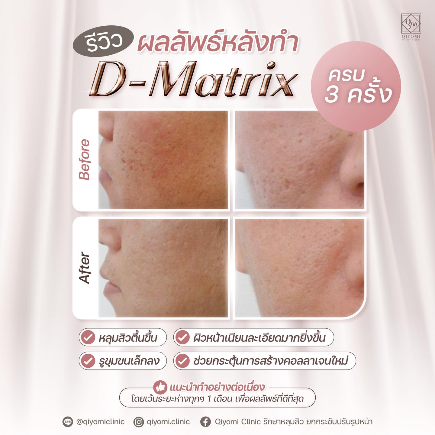 D-Matrix เป็นการเข้าไป "ปลุกระบบซ่อมแซมผิว" ให้กลับมาทำงานอีกครั้ง แบบลึกและแม่นยำ เหมาะกับใครที่รักษามาหลายวิธีแล้วไม่เห็นผล หรืออยากได้ทางเลือกที่ไม่ต้องลอกผิว โดยไม่ต้องพักฟื้น