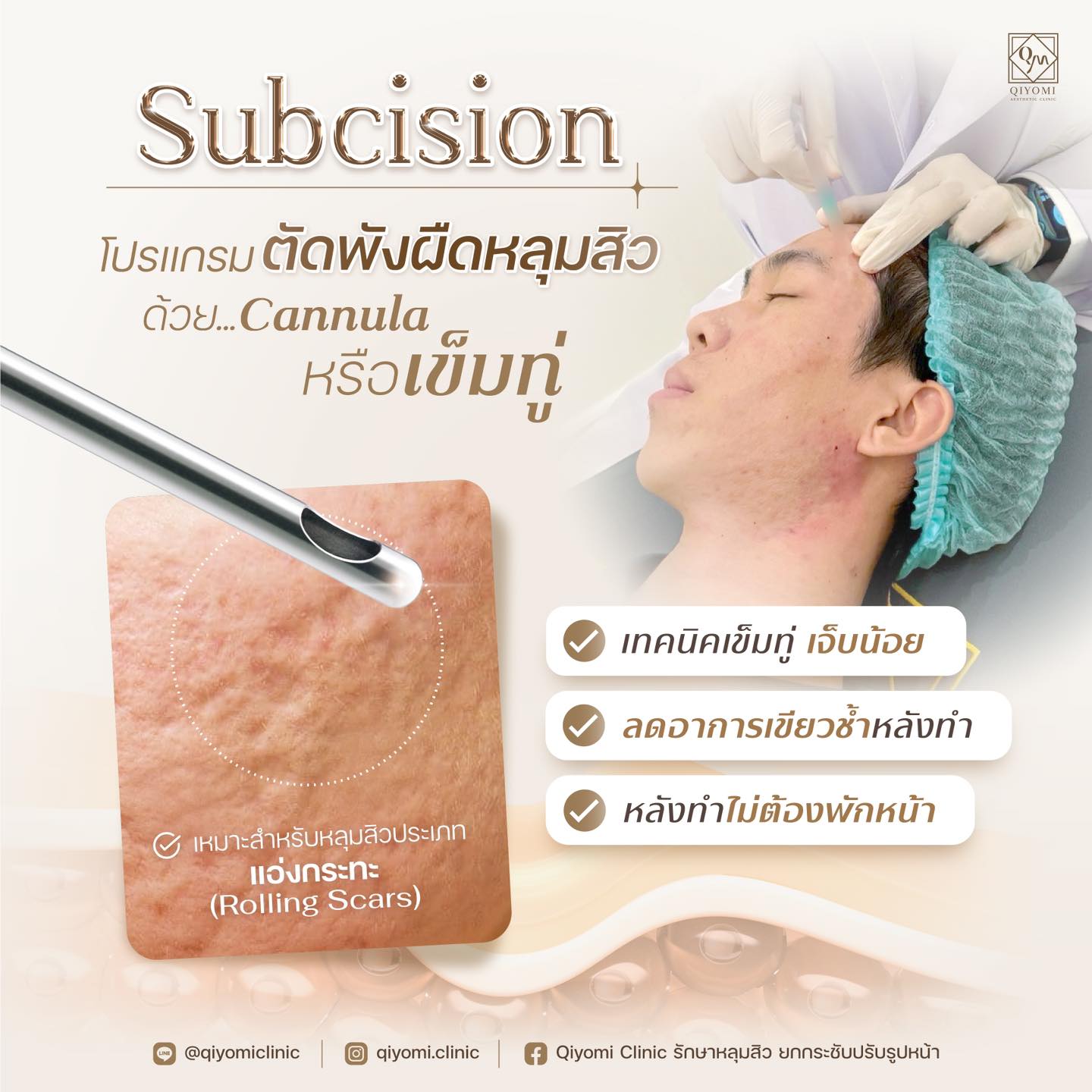 Subcision หลุมสิว เหมาะสำหรับผู้ที่มีหลุมสิวลึกที่เกิดจากการยึดรั้งของพังผืดใต้ผิวหนัง เห็นเป็นร่องชัดเจน และไม่สามารถรักษาให้ดีขึ้นด้วยการทาครีม ใช้ยา หรือเลเซอร์เพียงอย่างเดียว