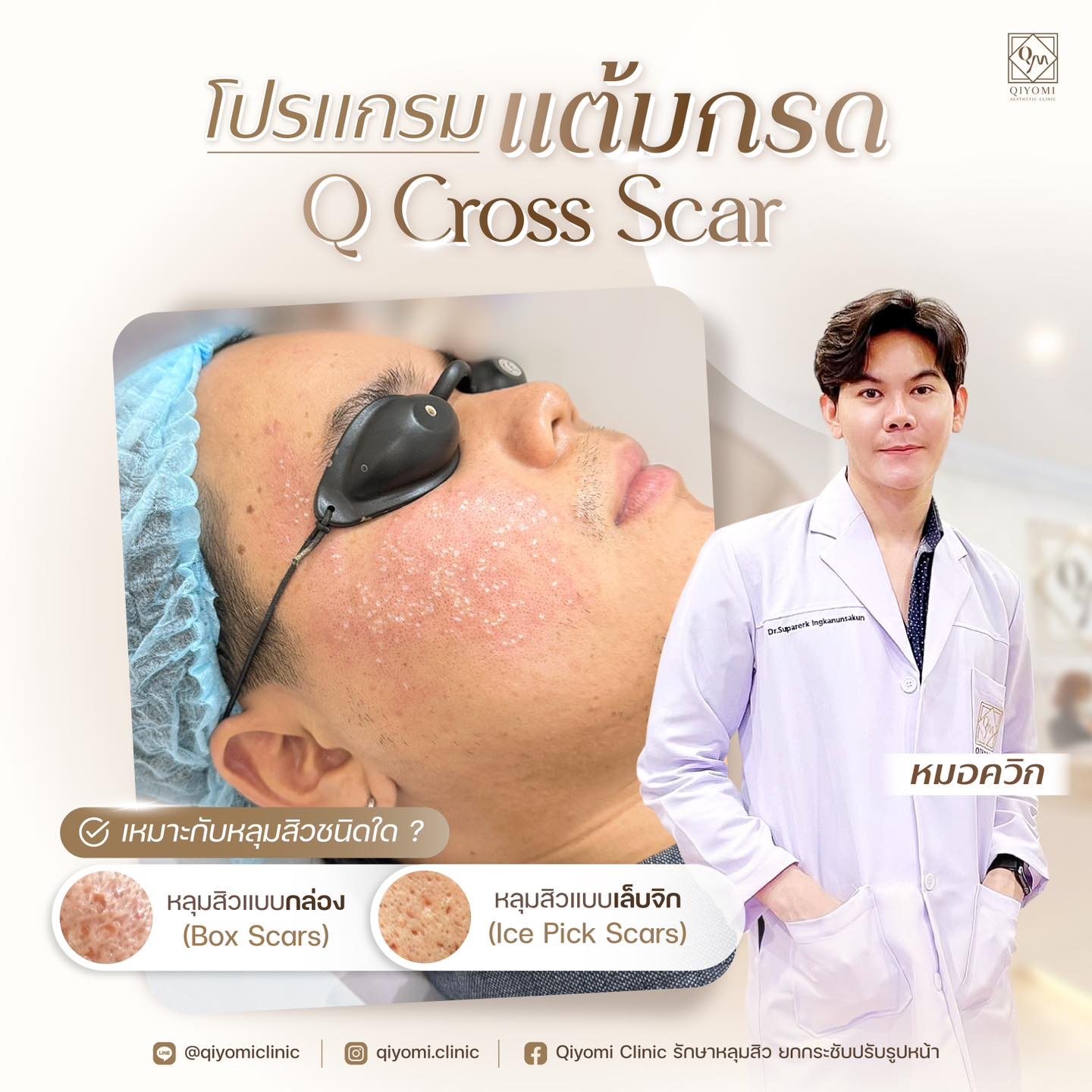 Q Cross Scar จะเหมาะกับหลุมสิวที่มีขนาดลึก และขอบปากขม ซึ่งเป็นหลุมสิวแบบจิก Ice Pick Scars และหลุมสิวแบบกล่อง Box Scars ซึ่งเป็นหลุมสิวชนิดที่รักษายาก มักไม่ค่อยได้ผลกับการรักษาด้วยการทำเลเซอร์