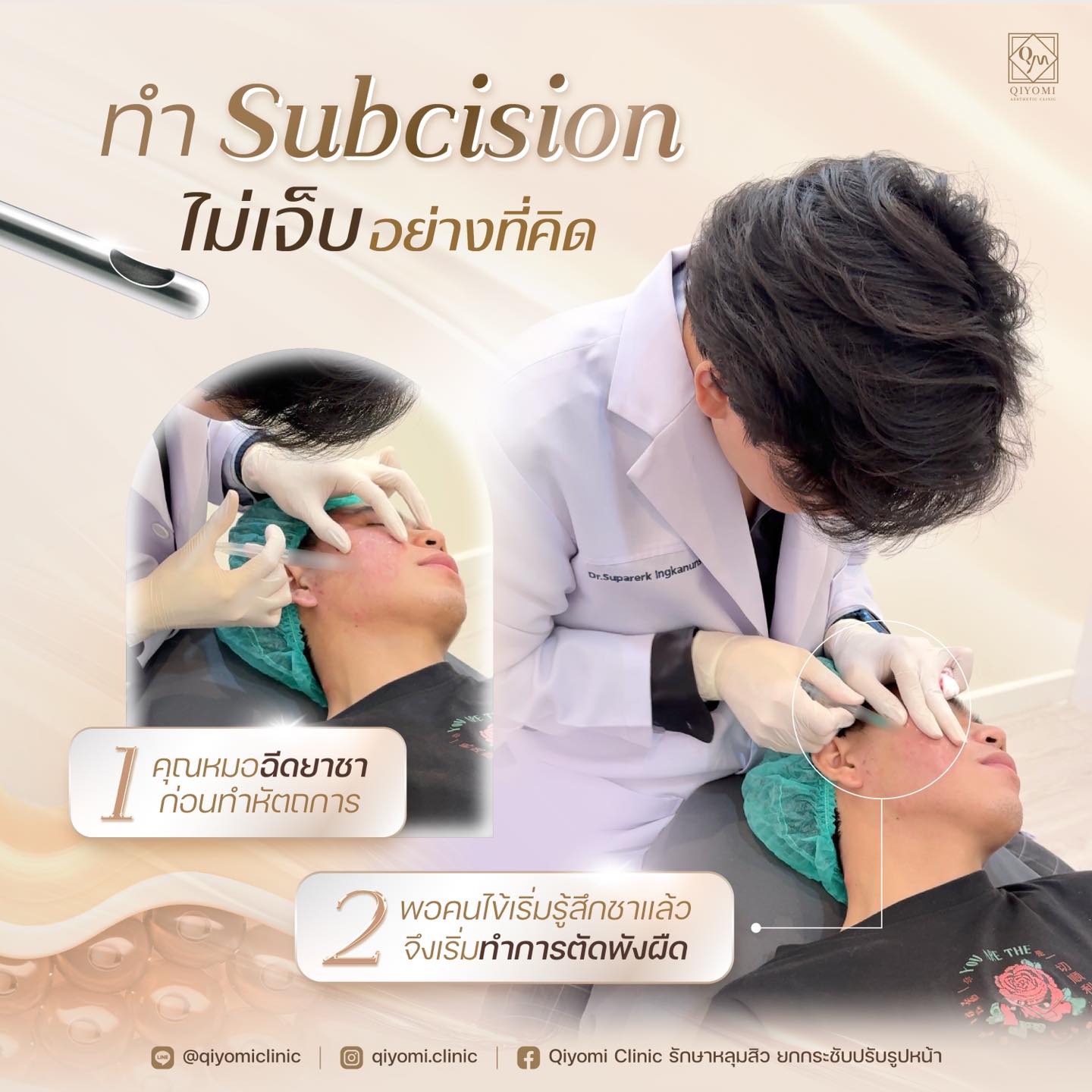Subcision หลุมสิว ไม่ได้มีความซับซ้อนมาก แต่จำเป็นต้องทำโดยแพทย์ผู้ชํานาญการ ที่มีประสบการณ์เฉพาะทางด้านการรักษาสิวโดยเฉพาะ