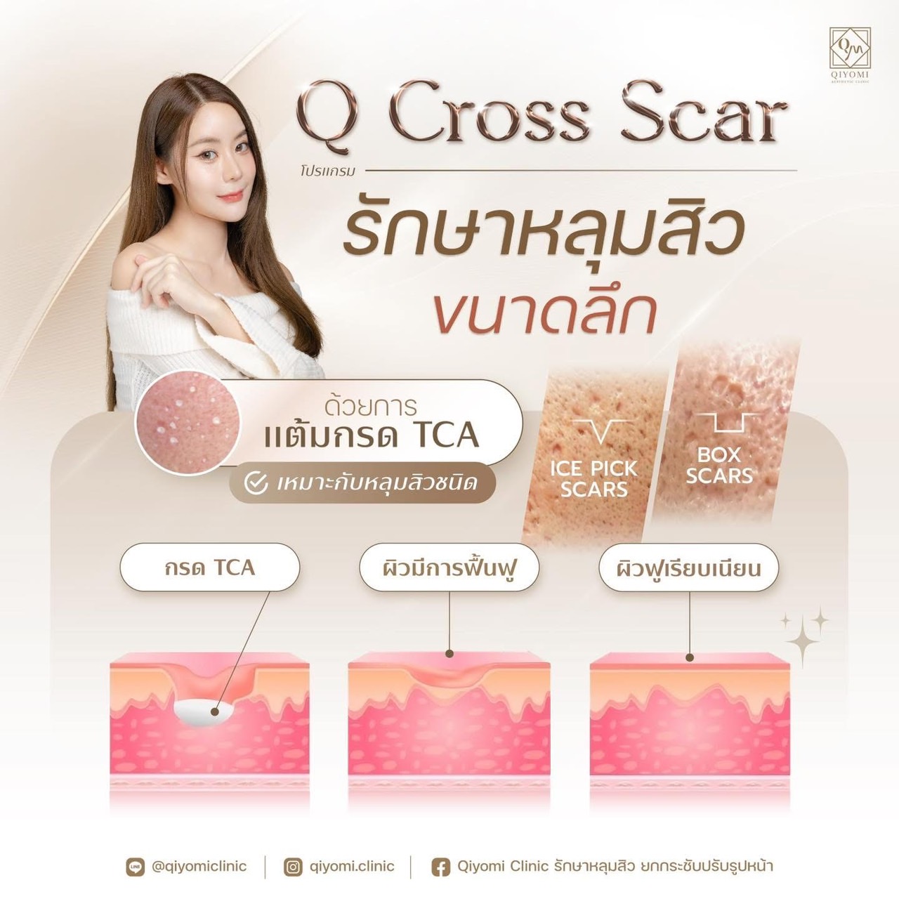 Q Cross Scar ก็คือการทำ TCA Cross นั่นเอง ซึ่งเป็นการรักษาหลุมสิวด้วยวิธีการแต้มกรด TCA โดยการแต้มกรด