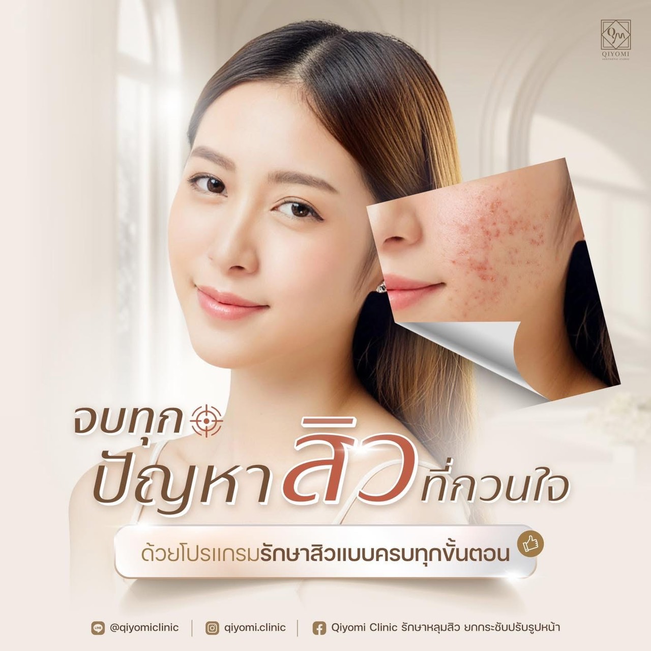 รักษาสิวที่ คิโยมิคลินิก มีเทคโนโลยีทันสมัย ครบ จบในที่เดียว ไม่ว่าจะเป็นเลเซอร์รักษาหลุมสิว, การกระตุ้นคอลลาเจน, การใช้เข็มพิเศษ หรือเทคนิคเฉพาะทางอื่น ๆ เราเลือกใช้เทคโนโลยีที่มีประสิทธิภาพสูง ปลอดภัย และเห็นผลจริงในระยะเวลาสั้น