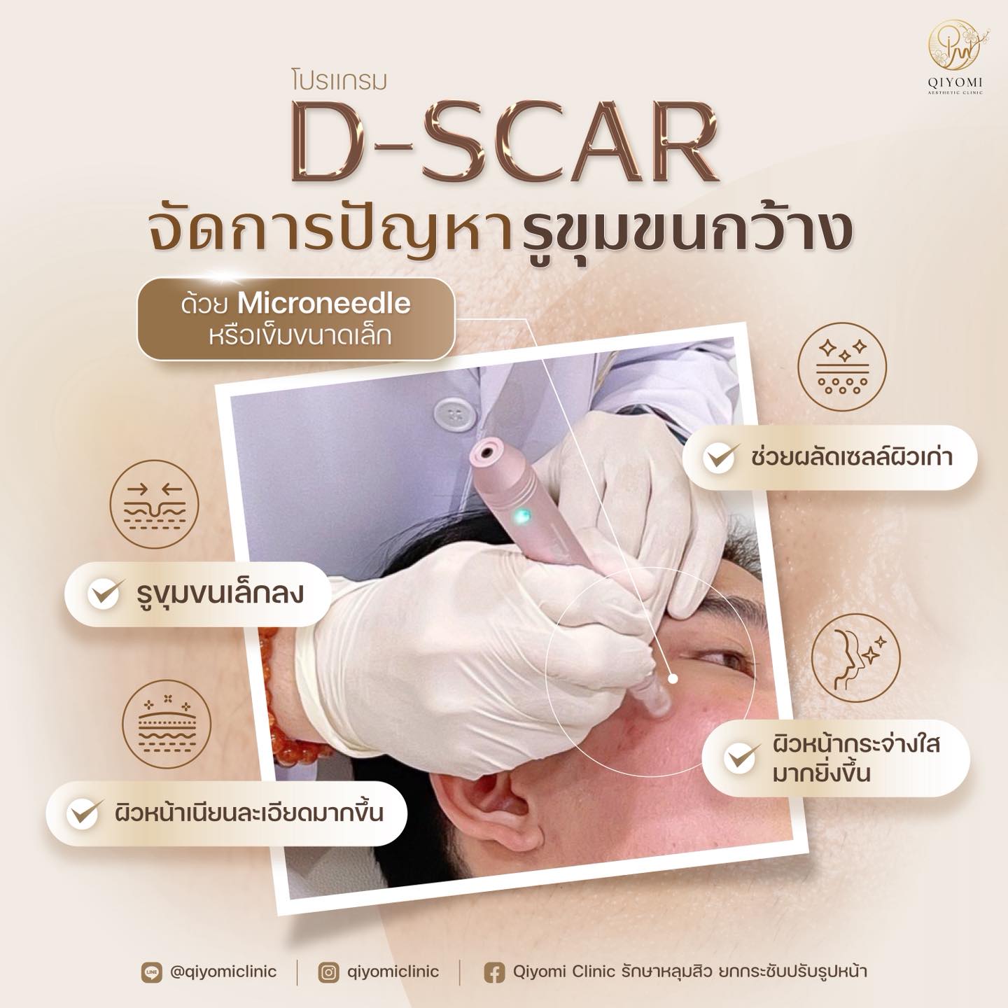 รักษารูขุมขนกว้าง ด้วยโปรแกรม D-SCAR เป็นการทำหัตถการด้วยเข็มที่มีขนาดเล็กมาก หรือ Microneedle โดยแพทย์จะใช้เข็มในการกรอผิวชั้นบน ซึ่งจะช่วยให้เกิดการผลัดเซลล์ผิว เผยผิวใหม่ที่เนียนละเอียด และกระจ่างใสมากยิ่งขึ้น